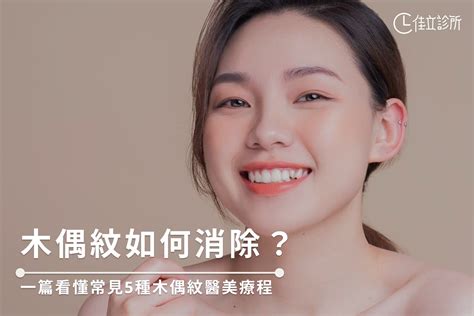 木偶紋|木偶紋如何消除？一篇看懂常見5種木偶紋醫美療程